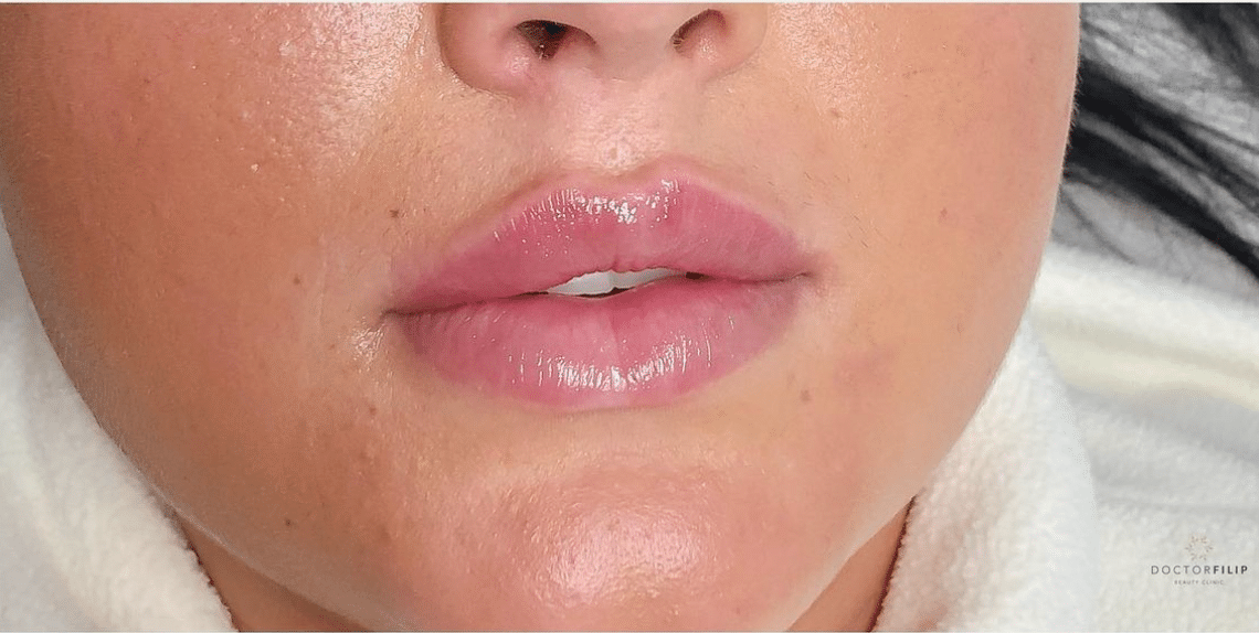 lip enhancement efter